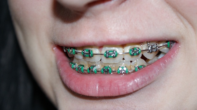 braces