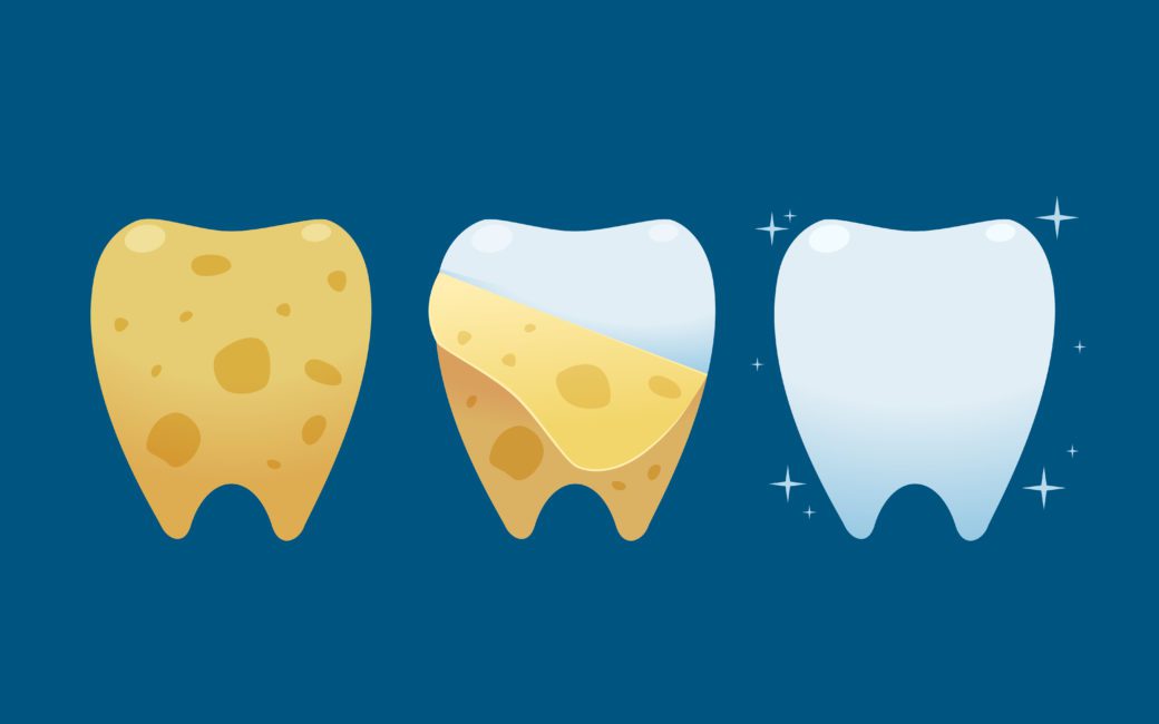 cavity history