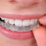 teeth straightening with invisalign