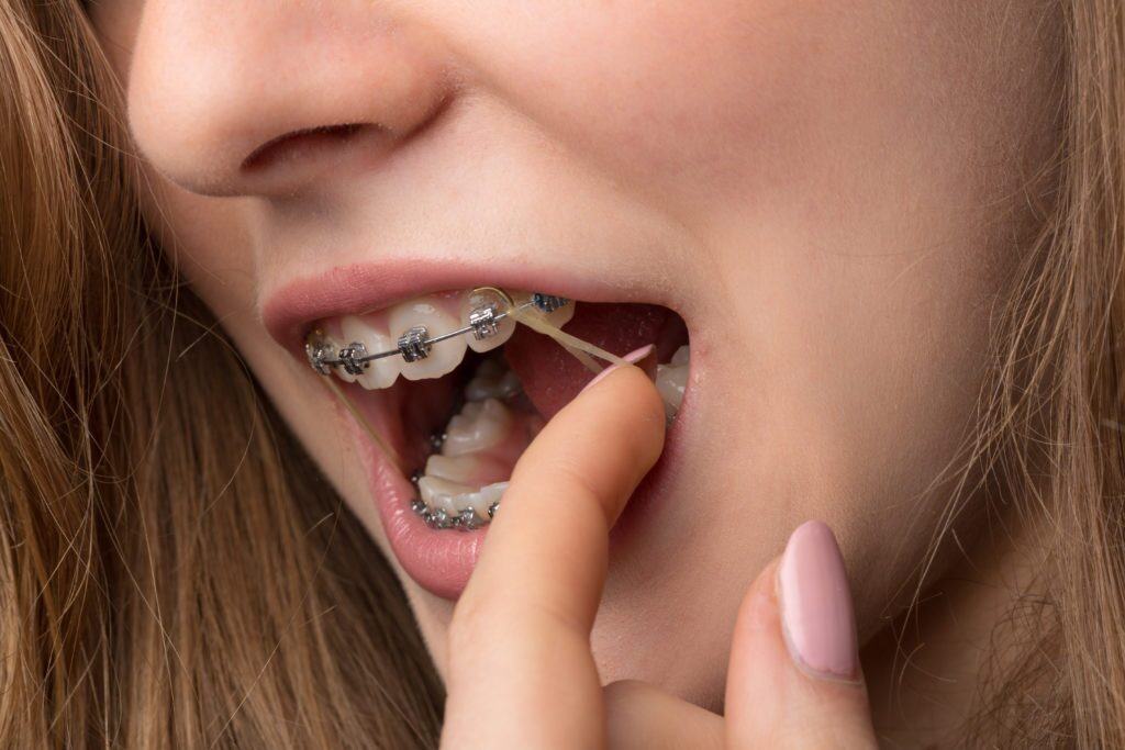 Ever wondered why are there rubber bands on braces? They're actually very important for your orthodontic treatment plan. Find out why.